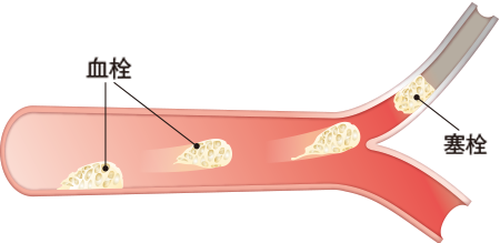 図1　血栓と塞栓