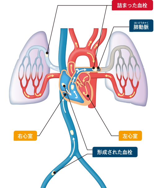 図2　血流と肺血栓