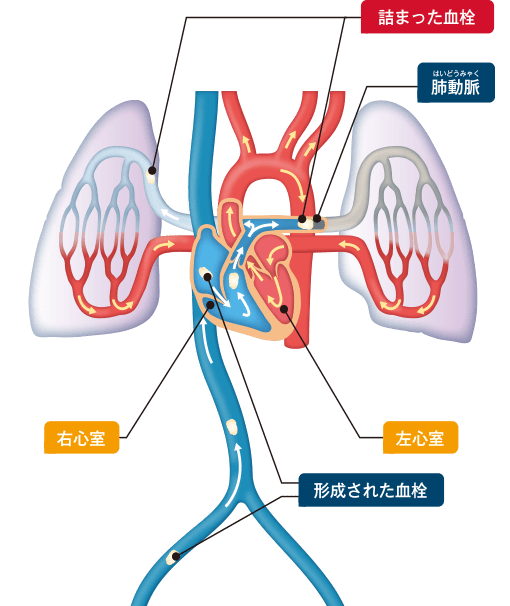 図2　血流と肺血栓