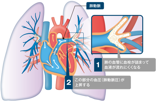 図2　CTEPHによる肺動脈圧上昇