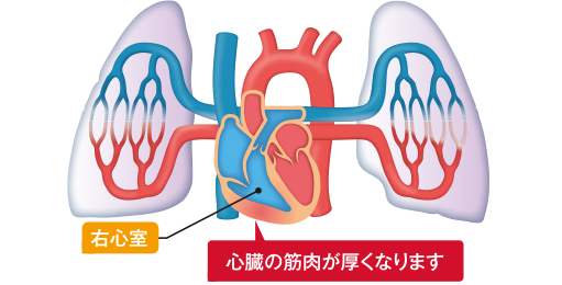 図3　右室肥大