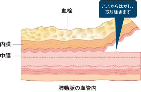 外科治療 - 血栓を取り除く手術