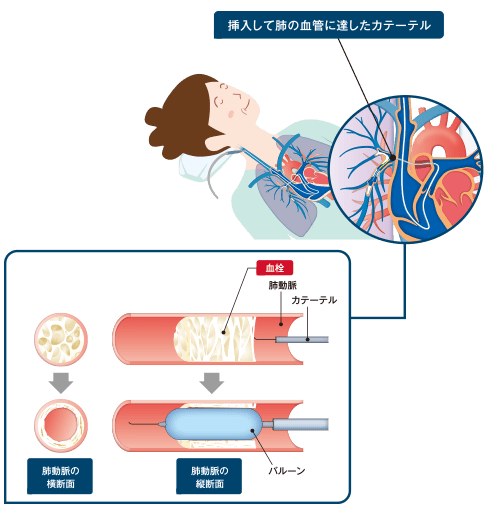 カテーテル治療